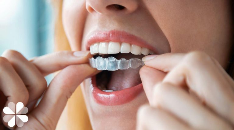 ¿Qué tipo de ortodoncia elegir? Guía sencilla para decidirte